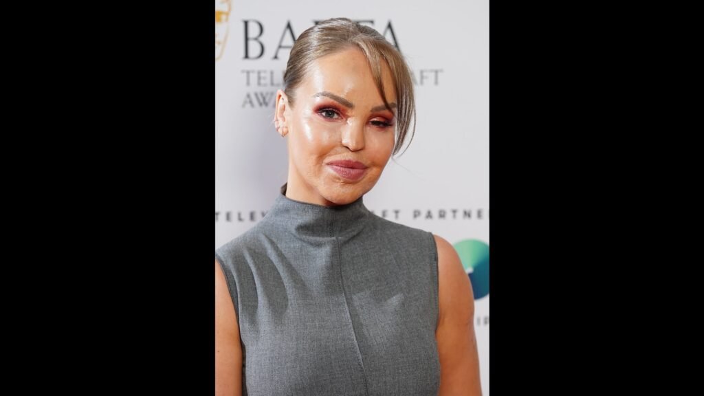 Katie Piper shares decision to get artificial eye 16 years after acid attack | Health Katie Piper shares decision to get artificial eye 16 years after acid attack | Health