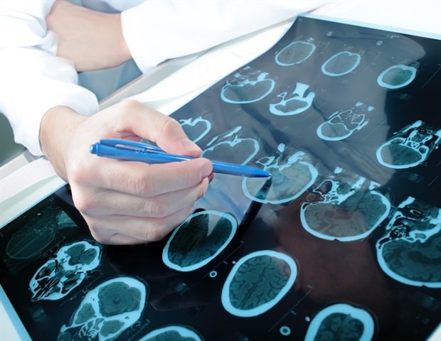 New research reveals potential biomarkers for epilepsy diagnosis
